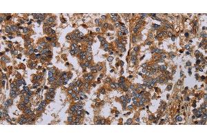 Immunohistochemistry of paraffin-embedded Human liver cancer using GDF2 Polyclonal Antibody at dilution of 1:40 (GDF2 antibody)