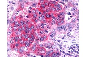 Anti-TAAR6 antibody IHC of human Ovary, Carcinoma. (TAAR6 antibody  (Cytoplasmic Domain))