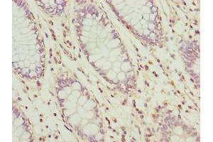 Immunohistochemistry of paraffin-embedded human colon cancer using ABIN7174542 at dilution of 1:100 (UBL3 antibody  (AA 17-114))