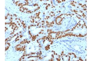Formalin-fixed, paraffin-embedded human Prostate Carcinoma stained with FOXA1 Monoclonal Antibody (FOXA1/1519). (FOXA1 antibody  (AA 372-472))