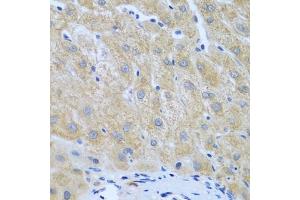 Immunohistochemistry of paraffin-embedded human liver cancer using Furin antibody (ABIN6127933, ABIN6140815, ABIN6140817 and ABIN6223322) at dilution of 1:100 (40x lens).
