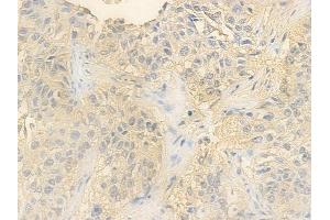 ABIN6260296 and ABIN6278210 at 1/100 staining human lung squamous cell carcinoma by IHC-P.