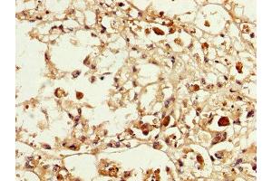 IHC image of ABIN7159260 diluted at 1:200 and staining in paraffin-embedded human melanoma performed on a Leica BondTM system. (MAGEA3 antibody  (AA 2-104))