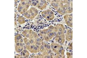 Immunohistochemical analysis of DLST staining in human liver cancer formalin fixed paraffin embedded tissue section.