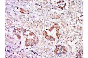 Paraformaldehyde-fixed, paraffin embedded human cervical cancer, Antigen retrieval by boiling in sodium citrate buffer (pH6) for 15min, Block endogenous peroxidase by 3% hydrogen peroxide for 30 minutes, Blocking buffer (normal goat serum) at 37°C for 20min, Antibody incubation with Rabbit Anti-Cathepsin L Polyclonal Antibody, Unconjugated  at 1:200 overnight at 4°C, followed by a conjugated secondary and DAB staining.