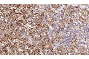 ABIN6279591 at 1/100 staining Human liver cancer tissue by IHC-P.
