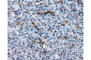 Immunohistochemical staining of paraffin-embedded Adenocarcinoma of ovary tissue using anti-CD36 mouse monoclonal antibody. (CD36 antibody)