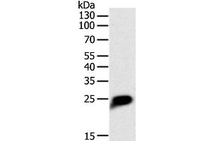 Western Blot analysis of Human liver cancer tissue using CRP Polyclonal Antibody at dilution of 1:1400 (CRP antibody)