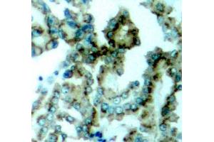 Immunohistochemistry of paraffin-embedded human lung carcinoma tissue, using Phospho-PKCalpha/beta II-T638/641 antibody (ABIN2987563). (PKC beta antibody  (pThr641))