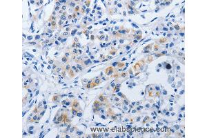 Immunohistochemistry of Human lung cancer using BPIFB3 Polyclonal Antibody at dilution of 1:50