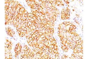 Immunohistochemical staining (Formalin-fixed paraffin-embedded sections) of human renal cell carcinoma with CA9 monoclonal antibody, clone SPM314 . (CA9 antibody)