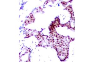 Immunohistochemical analysis of paraffin-embedded human breast carcinoma tissue using Phospho-RELA-S276 antibody. (NF-kB p65 antibody  (pSer276))