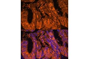 Immunofluorescence analysis of human colon carcinoma using Galectin 4/LG Polyclonal Antibody (ABIN7267339) at dilution of 1:100 (40x lens). (GAL4 antibody  (AA 1-100))