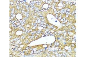 Immunohistochemistry of paraffin-embedded Human colon carcinoma using MLKL Polyclonal Antibody at dilution of 1:200 (40x lens). (MLKL antibody)