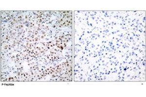 Immunohistochemical analysis of paraffin-embedded human breast carcinoma tissue using CREB1 (phospho S133) polyclonal antibody . (CREB1 antibody  (pSer133))