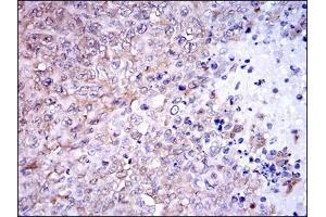 Immunohistochemical analysis of paraffin-embedded ovarian cancer tissues using NQO1 mouse mAb with DAB staining. (NQO1 antibody)