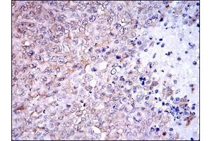 Immunohistochemical analysis of paraffin-embedded ovarian cancer tissues using NQO1 mouse mAb with DAB staining. (NQO1 antibody)