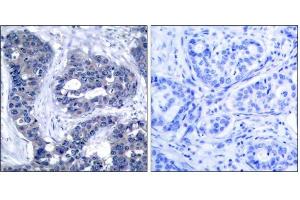 Immunohistochemical analysis of paraffin-embedded human breast carcinoma tissue, using IRS-1 (phospho-Ser639) antibody (E011231). (IRS1 antibody  (pSer639))