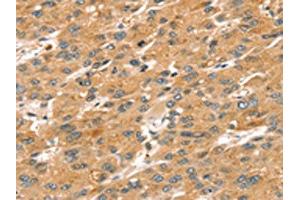 The image on the left is immunohistochemistry of paraffin-embedded Human liver cancer tissue using ABIN7192624(SPATA18 Antibody) at dilution 1/20, on the right is treated with synthetic peptide.