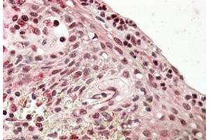 Immunohistochemistry (Paraffin-embedded Sections) (IHC (p)) image for anti-PR Domain Containing 1, with ZNF Domain (PRDM1) (Internal Region) antibody (ABIN615923) (PRDM1 antibody  (Internal Region))