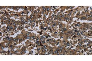 Immunohistochemistry of paraffin-embedded Human liver cancer using CD42b Polyclonal Antibody at dilution of 1:60 (CD42b antibody)
