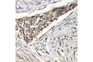 Immunohistochemistry of paraffin-embedded human esophagus cancer using FZR1 antibody at dilution of 1:200 (40x lens). (FZR1 antibody)