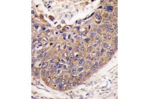 Formalin-fixed and paraffin-embedded human lung carcinoma tissue reacted with FXN antibody (C-term) (ABIN390377 and ABIN2840779) , which was peroxidase-conjugated to the secondary antibody, followed by DAB staining. (Frataxin antibody  (C-Term))