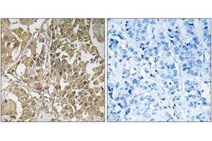 Immunohistochemistry analysis of paraffin-embedded human breast carcinoma tissue, using BUB1 Antibody. (BUB1 antibody  (AA 251-300))