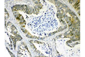IHC analysis of AKR1B10 using anti- AKR1B10 antibody . (AKR1B10 antibody  (C-Term))