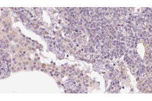 ABIN6273159 at 1/100 staining Human lymph cancer tissue by IHC-P.