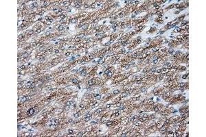 Immunohistochemical staining of paraffin-embedded Carcinoma of liver tissue using anti-NIT2 mouse monoclonal antibody. (NIT2 antibody)
