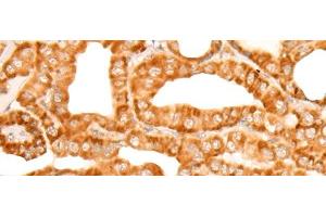 Immunohistochemistry of paraffin-embedded Human thyroid cancer tissue using ZMYND10 Polyclonal Antibody at dilution of 1:35(x200) (ZMYND10 antibody)