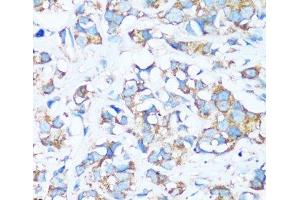 Immunohistochemistry of paraffin-embedded Human breast cancer using ARHGEF5 Polyclonal Antibody at dilution of 1:100 (40x lens).