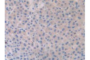 IHC-P analysis of Human Liver Cancer Tissue, with DAB staining. (SLIT1 antibody  (AA 647-835))