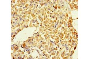 Immunohistochemistry of paraffin-embedded human melanoma using ABIN7145605 at dilution of 1:100 (MUTED antibody  (AA 2-187))