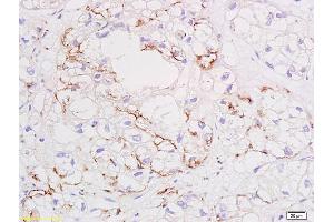 Formalin-fixed and paraffin embedded human colon carcinoma tissue labeled with Anti VEGF Polyclonal Antibody,Unconjugated (ABIN674829) at 1:200 followed by conjugation to the secondary antibody and DAB staining.