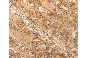 Immunohistochemistry of Human gastic cancer using ADRA1B Polyclonal Antibody at dilution of 1:20