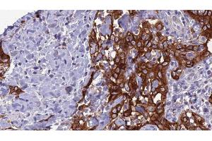 ABIN6266638 at 1/100 staining Human Head and neck cancer tissue by IHC-P. (Synaptophysin antibody  (Internal Region))