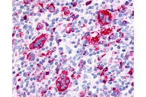 Anti-F2RL3 / PAR4 antibody IHC of human Lymph Node, Hodgkins Lymphoma. (F2RL3 antibody  (Extracellular Domain))
