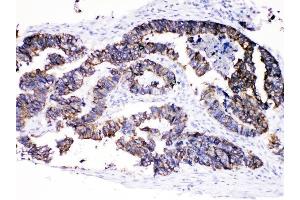 IHC analysis of Cytokeratin 8 using anti-Cytokeratin 8 antibody (ABIN5518853). (KRT8 antibody  (AA 107-325))
