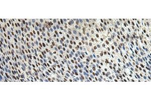 Immunohistochemistry of paraffin-embedded Human lung cancer tissue using DDX39A Polyclonal Antibody at dilution of 1:65(x200) (DDX39 antibody)