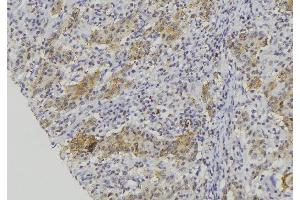 ABIN6273134 at 1/100 staining Human lung cancer tissue by IHC-P. (CMA1 antibody  (C-Term))