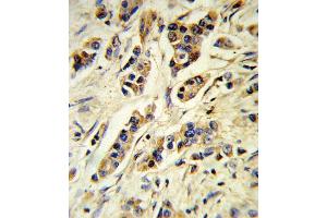 Formalin-fixed and paraffin-embedded human breast carcinoma reacted with IL10 Antibody , which was peroxidase-conjugated to the secondary antibody, followed by DAB staining. (IL-10 antibody  (AA 27-53))