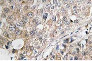 Immunohistochemistry (IHC) analyzes of MKP-1/2 antibody in paraffin-embedded human breast carcinoma tissue.