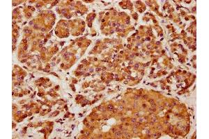 IHC image of ABIN7157587 diluted at 1:400 and staining in paraffin-embedded human pancreatic cancer performed on a Leica BondTM system. (KIF13A antibody  (AA 1383-1537))