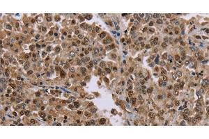 Immunohistochemistry of paraffin-embedded Human liver cancer tissue using MRGPRX1 Polyclonal Antibody at dilution 1:40 (MRGPRX1 antibody)
