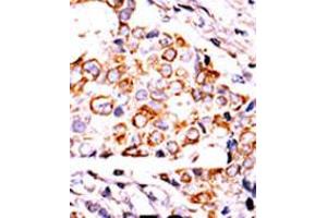 Formalin-fixed and paraffin-embedded human cancer tissue reacted with the primary antibody, which was peroxidase-conjugated to the secondary antibody, followed by DAB staining. (NME3 antibody  (AA 51-81))