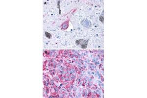 Immunohistochemical (Formalin/PFA-fixed paraffin-embedded sections) staining in human brain, substantia nigra (A) and human melanoma (B) with GPR50 polyclonal antibody . (GPR50 antibody  (C-Term))