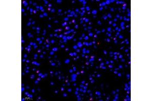 Immunofluorescence of paraffin embedded human liver cancer using RBM8A (ABIN7075478) at dilution of 1: 300 (400x lens) (RBM8A antibody)