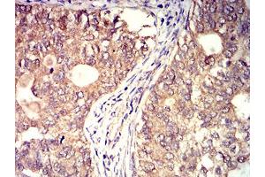 Immunohistochemical analysis of paraffin-embedded cervical cancer tissues using BTN2A2 mouse mAb with DAB staining.